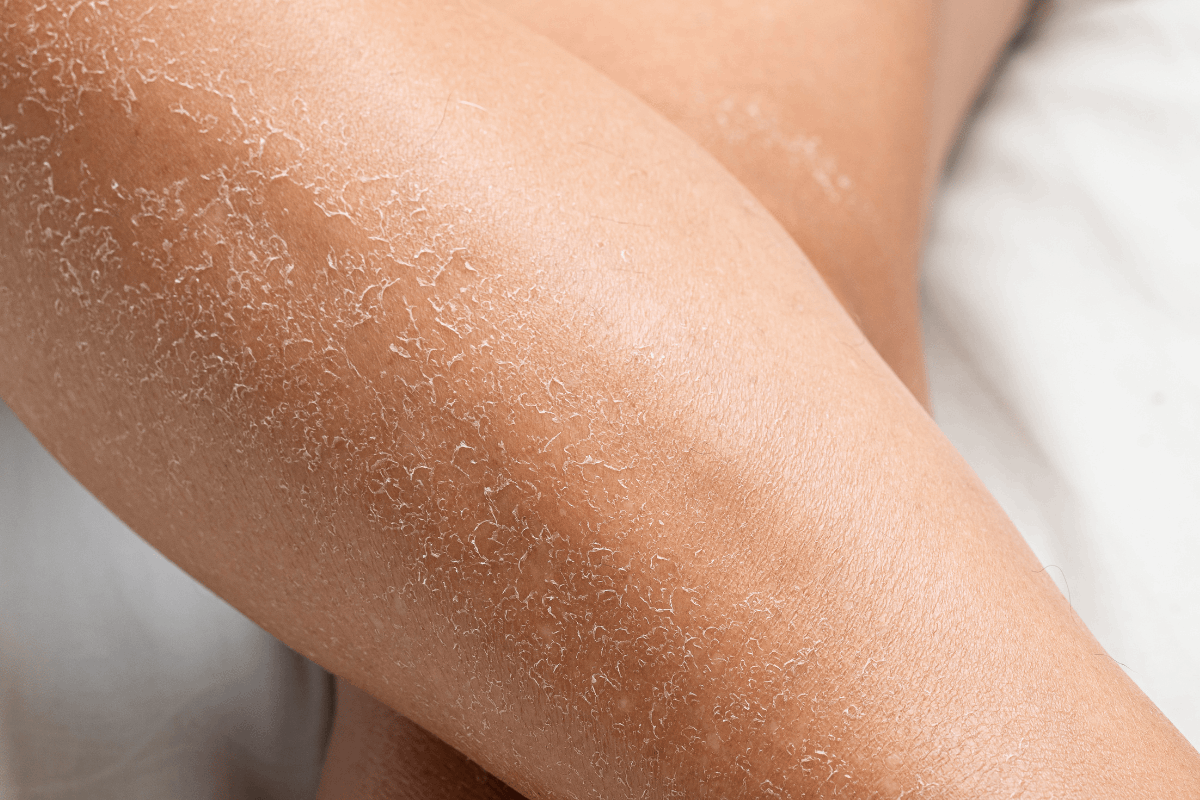 Clogged Skin Pore Woes? Here's How To Fix It