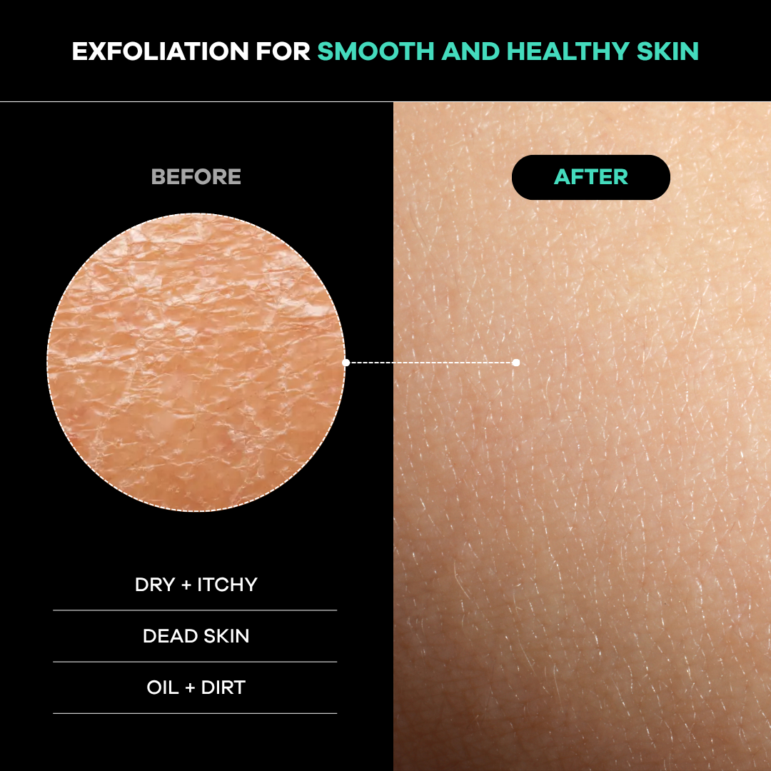 Before and after comparison of skin exfoliation showing smooth and healthy skin.